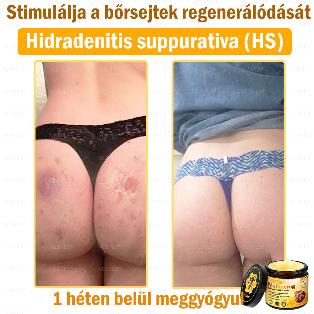 💪💪VLSVLS® Méhméreg Bőrhelyreállító Krém (👨⚕CE jóváhagyott)👍✅
