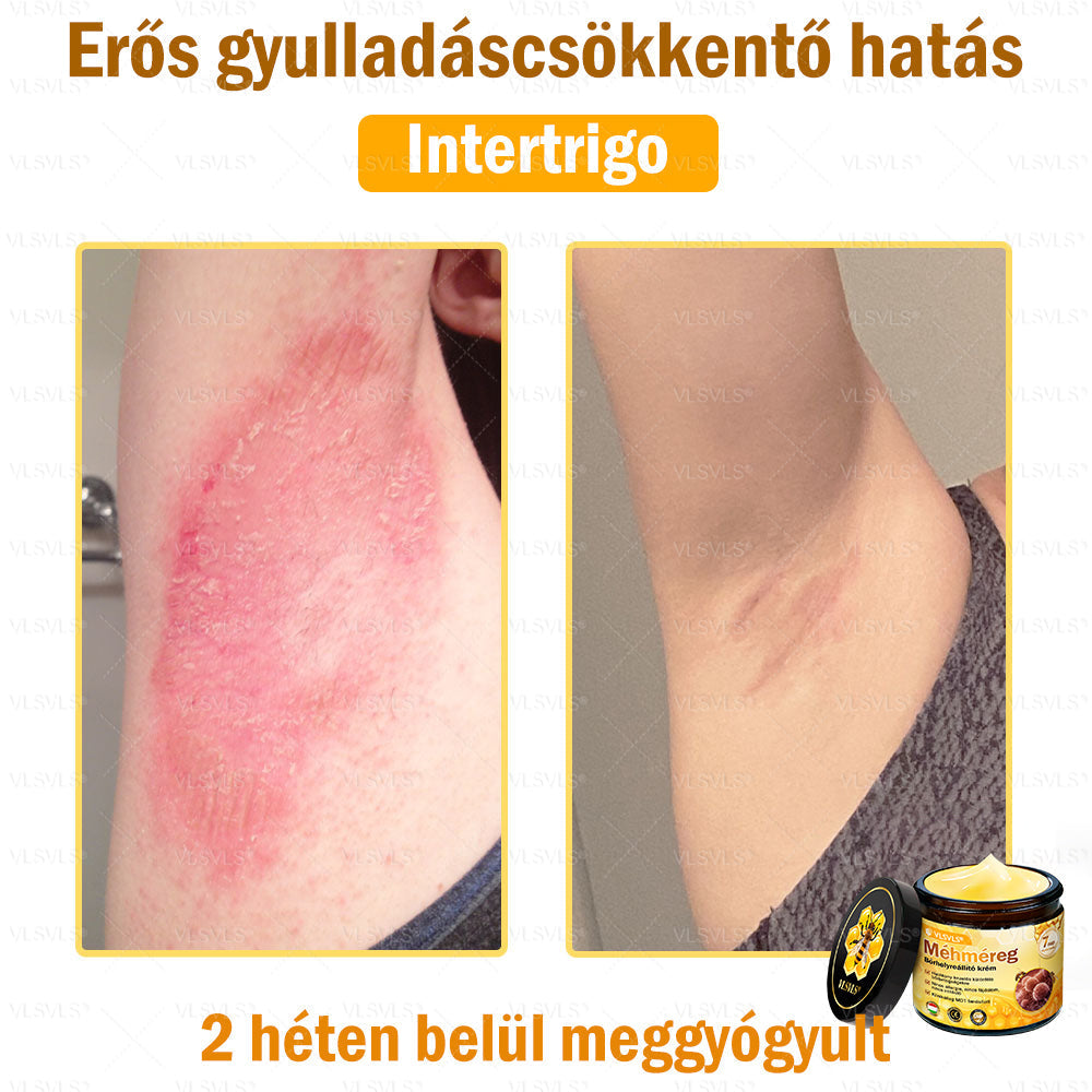 💪💪VLSVLS® Méhméreg Bőrhelyreállító Krém (👨⚕CE jóváhagyott)👍✅