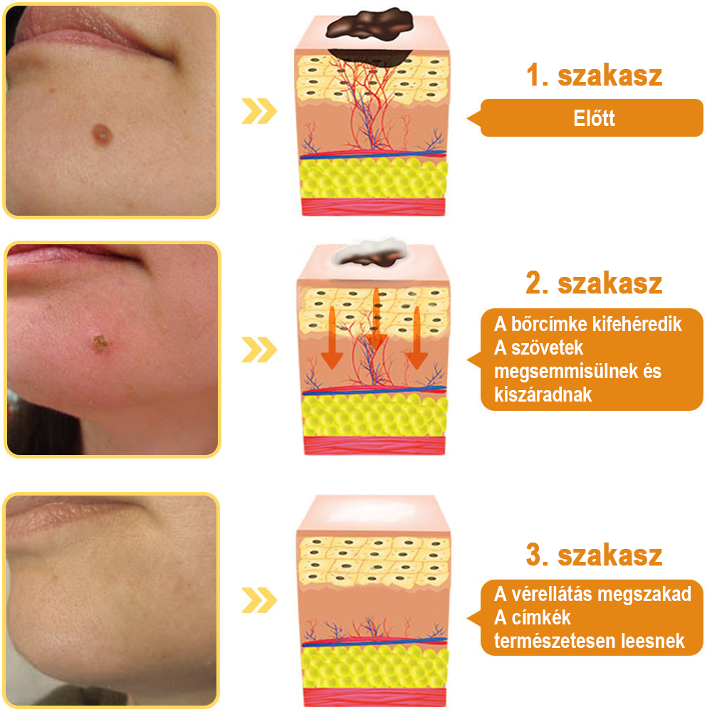 【💗utánvétel (COD)💗】Méhméreg szemölcs és övsömör eltávolító spray (👨⚕AAD Ajánlott) 🐝🐝🔥(🔥Last Day 80% Off)