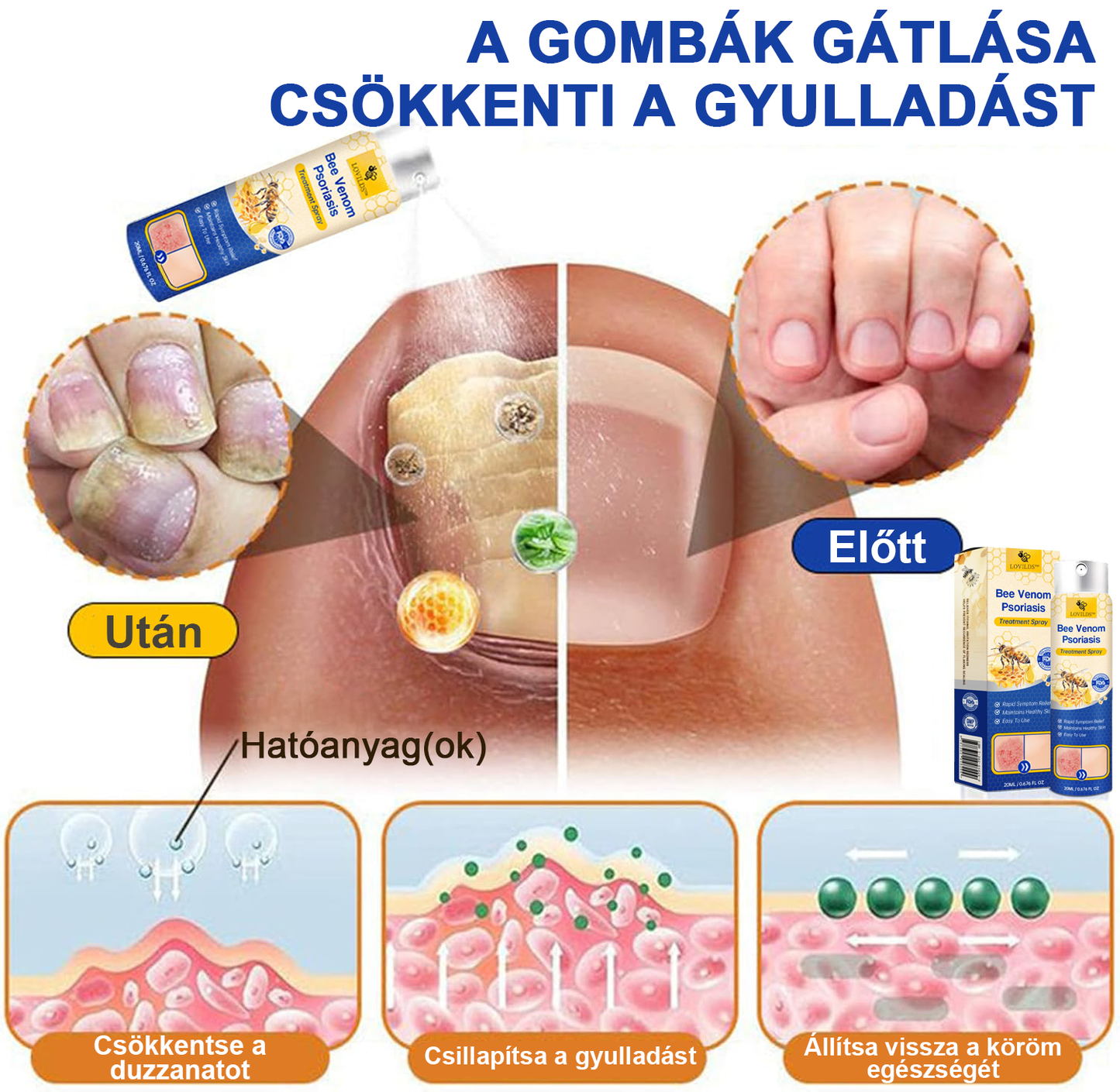 (đ„UtĂĄnvĂ©ttelđ„60% KEDVEZMĂNY) LOVILDSâą PsoriaHeal Psoriasis Spray (SzĂĄllĂtĂĄs vilĂĄgszerte â Ingyenes szĂĄllĂtĂĄs) đ