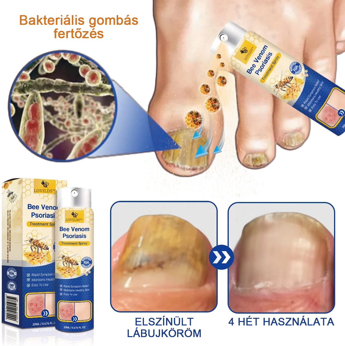 (đ„UtĂĄnvĂ©ttelđ„60% KEDVEZMĂNY) LOVILDSâą PsoriaHeal Psoriasis Spray (SzĂĄllĂtĂĄs vilĂĄgszerte â Ingyenes szĂĄllĂtĂĄs) đ