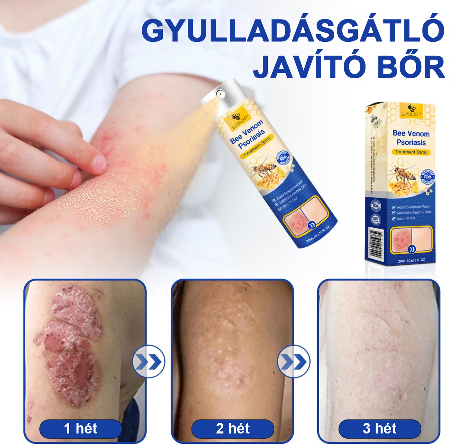 (đ„UtĂĄnvĂ©ttelđ„60% KEDVEZMĂNY) LOVILDSâą PsoriaHeal Psoriasis Spray (SzĂĄllĂtĂĄs vilĂĄgszerte â Ingyenes szĂĄllĂtĂĄs) đ