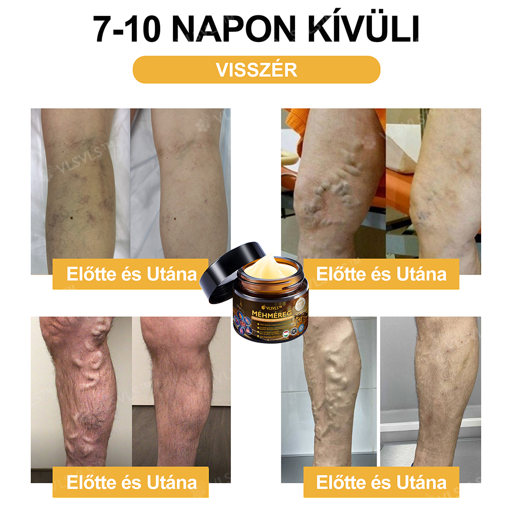 VLSVLS™ Méhméreg Azonnali Ultra Erős Fájdalomcsillapító Krém - (Enyhíti a fájdalmat ízületi gyulladás, izomfájdalom, hátfájás, térdek, hát, vállak, csípők, csuklók, kezek esetén)