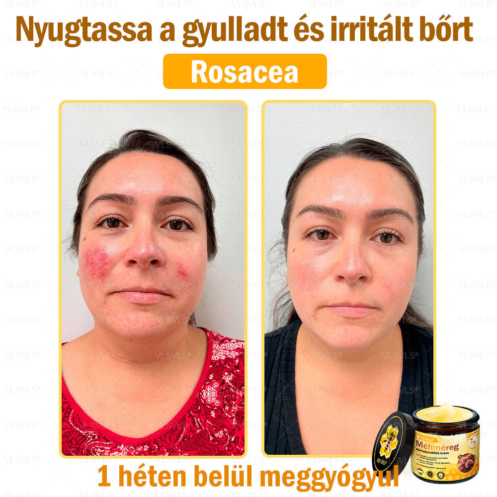 💪💪VLSVLS® Méhméreg Bőrhelyreállító Krém (👨⚕CE jóváhagyott)👍✅