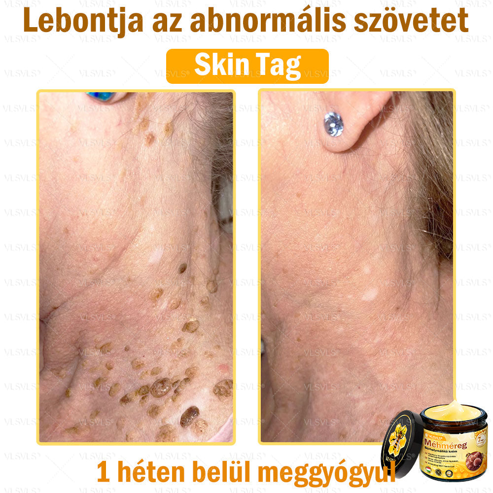 💪💪VLSVLS® Méhméreg Bőrhelyreállító Krém (👨⚕CE jóváhagyott)👍✅