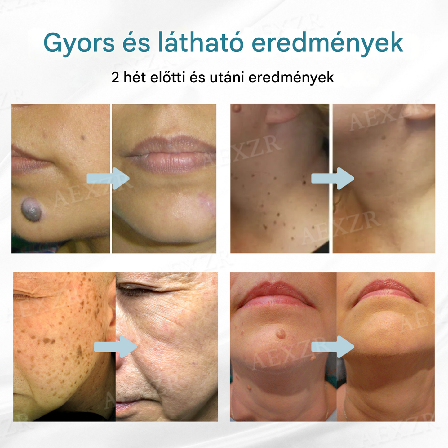 ✅Bikenda® non-invazív anyajegy- és szemölcseltávolító lézertoll