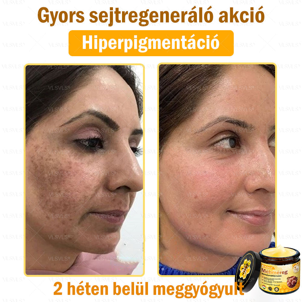 💪💪VLSVLS® Méhméreg Bőrhelyreállító Krém (👨⚕CE jóváhagyott)👍✅