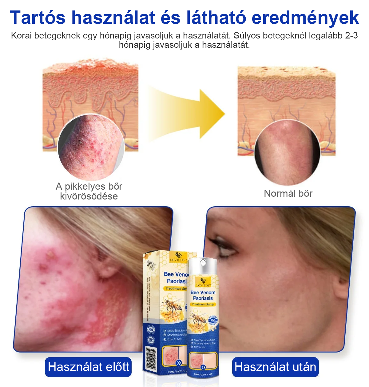 (🔥Utánvéttel🔥60% KEDVEZMÉNY) LOVILDS™ PsoriaHeal Psoriasis Spray (Szállítás világszerte – Ingyenes szállítás) 🌐