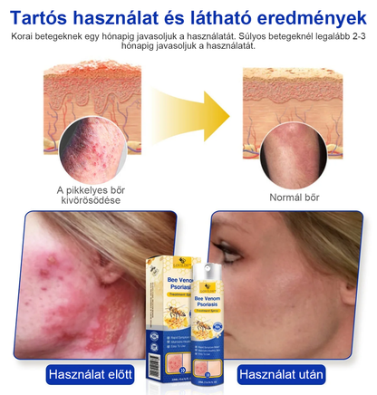 (🔥Utánvéttel🔥60% KEDVEZMÉNY) LOVILDS™ PsoriaHeal Psoriasis Spray (Szállítás világszerte – Ingyenes szállítás) 🌐