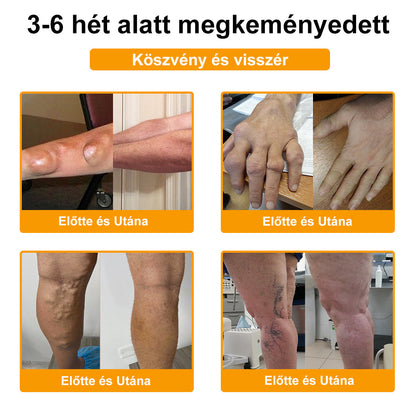 ADNOON® Botulinum Toxin & Méhméreg Fájdalomcsillapító Csontgyógyító Krém👨‍⚕️A Magyar Ortopéd Társaság (MOT) Által Jóváhagyva