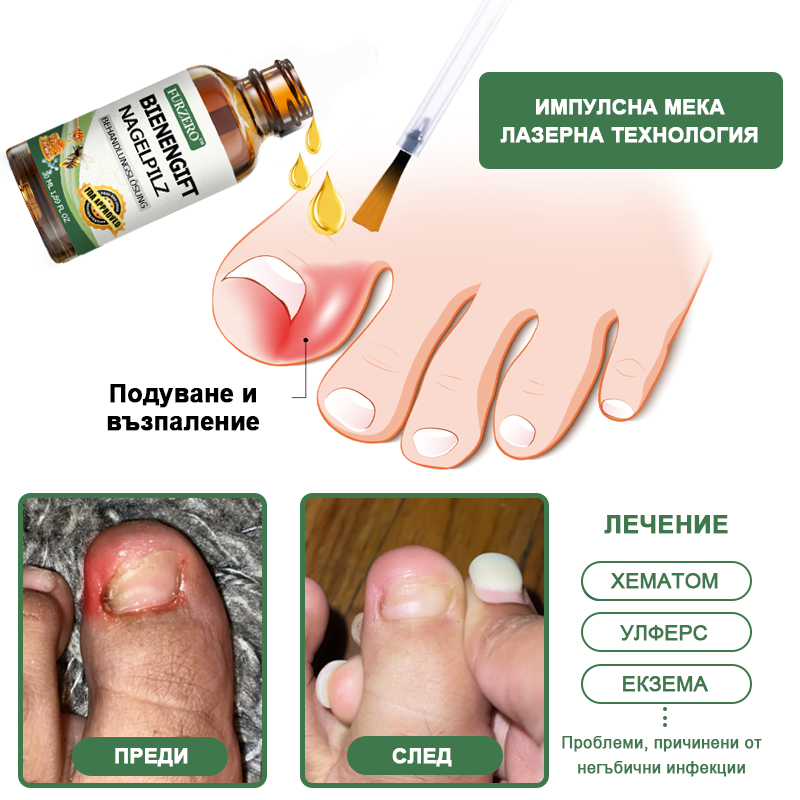 👩‍⚕️Furzero™Nail protection серум за лечение с пчелна отрова