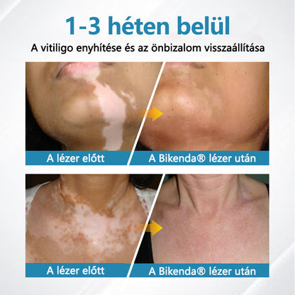 Bikenda® DermaBeam Vitiligo Therapy Device💙