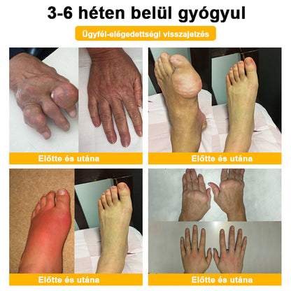 ADNOON® Botulinum Toxin & Méhméreg Fájdalomcsillapító Csontgyógyító Krém👨‍⚕️A Magyar Ortopéd Társaság (MOT) Által Jóváhagyva