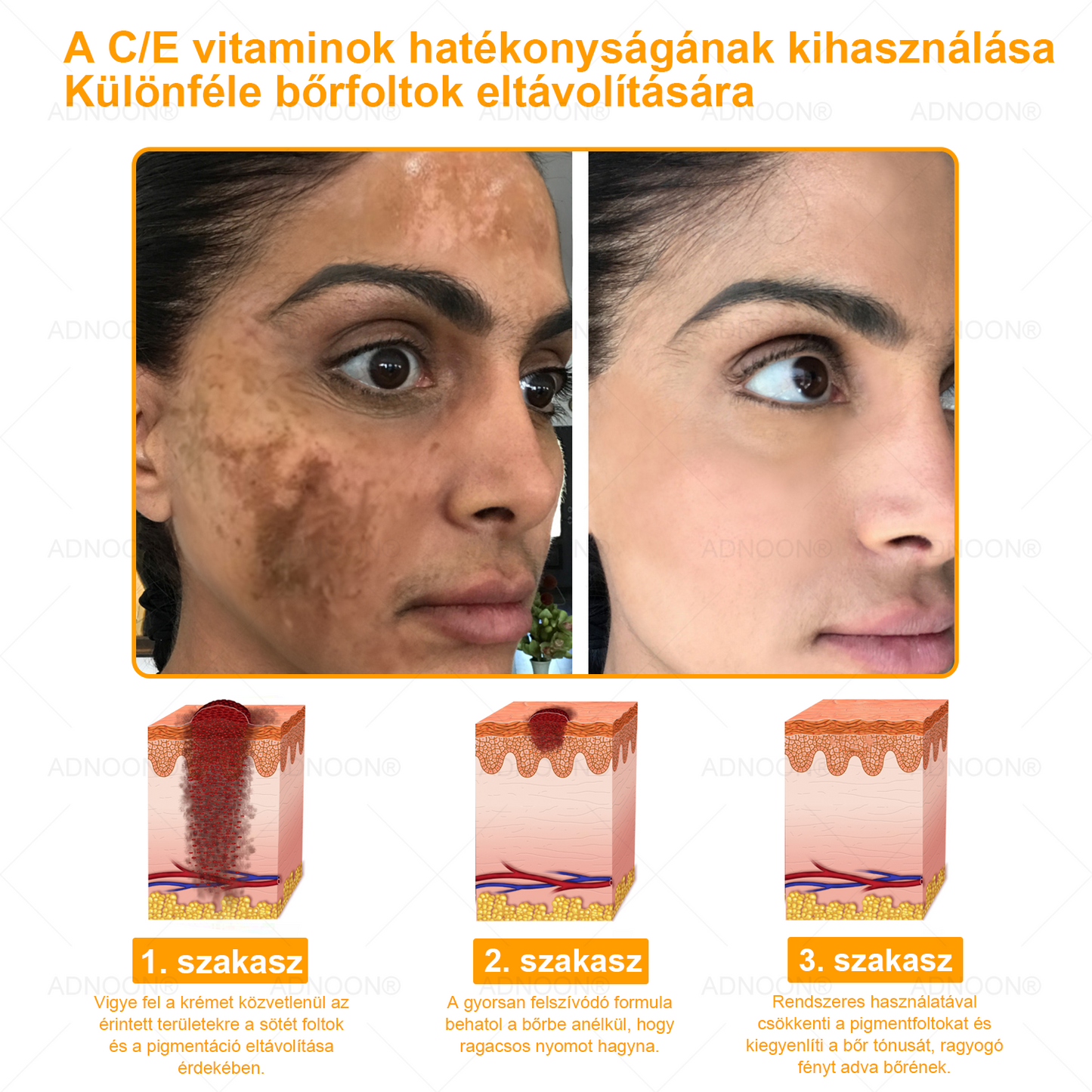 ADNOON® 🌼 7 napos erőteljes bőregészség-javító krém – ajánlja a Magyar Dermatológiai Társulat (MDT) 👨‍⚕️