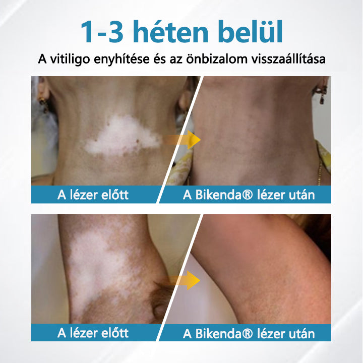 Bikenda® DermaBeam Vitiligo Therapy Device💙