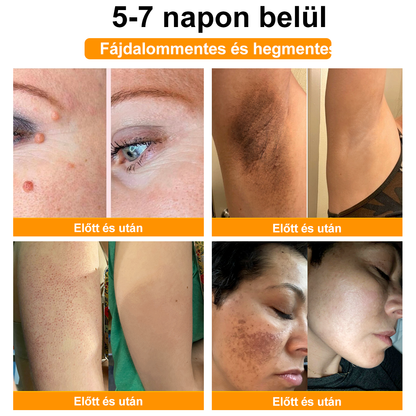 BSWELL® Méhméreg Kezelés Krém👨‍⚕️（AAD ajánlott） (🔥utolsó nap promóció 80% ki）