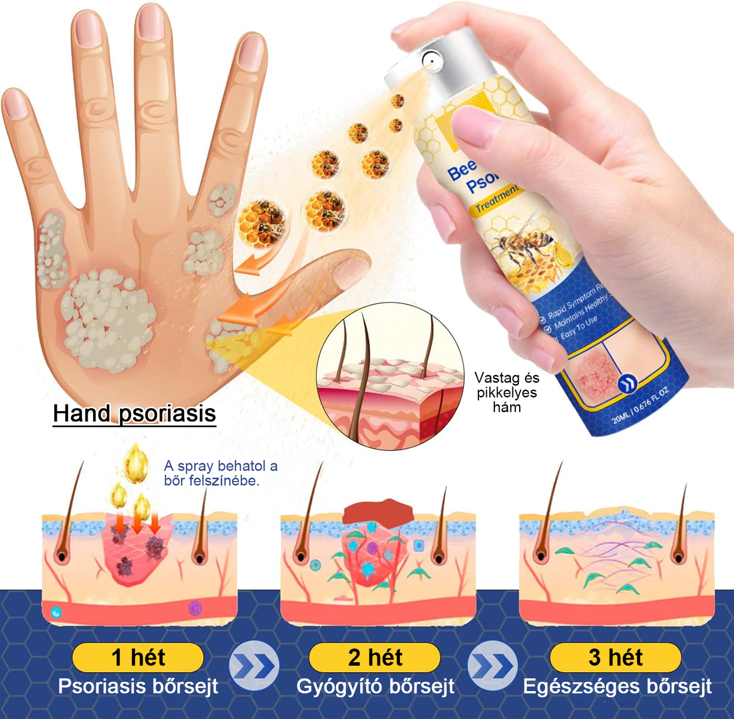 (🔥Utánvéttel🔥60% KEDVEZMÉNY) LOVILDS™ PsoriaHeal Psoriasis Spray (Szállítás világszerte – Ingyenes szállítás) 🌐