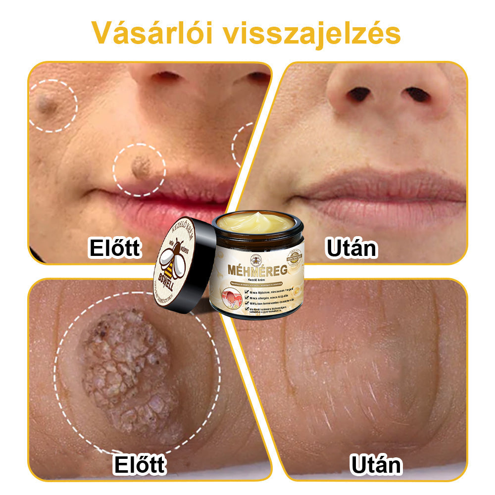 BSWELL® Méhméreg Kezelés Krém👨‍⚕️（AAD ajánlott） (🔥utolsó nap promóció 80% ki）
