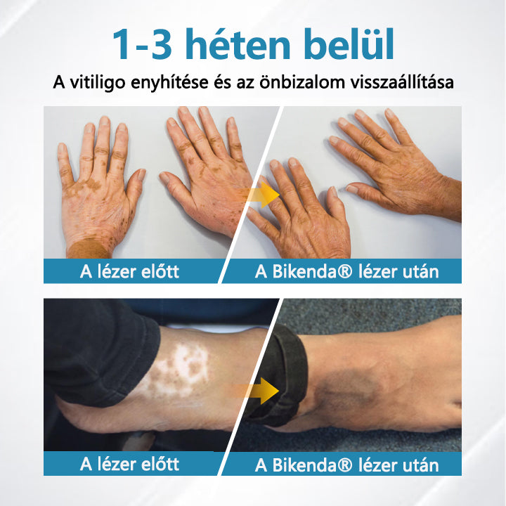 Bikenda® DermaBeam Vitiligo Therapy Device💙