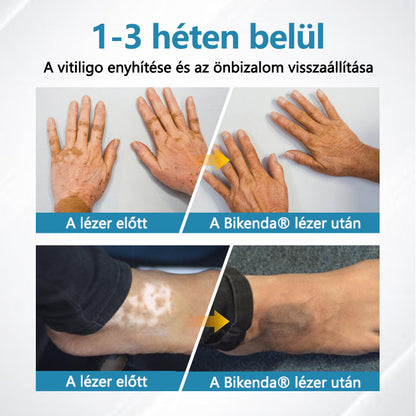 Bikenda® DermaBeam Vitiligo Therapy Device💙