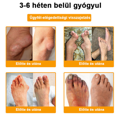 ADNOON® Botulinum Toxin & Méhméreg Fájdalomcsillapító Csontgyógyító Krém👨‍⚕️A Magyar Ortopéd Társaság (MOT) Által Jóváhagyva