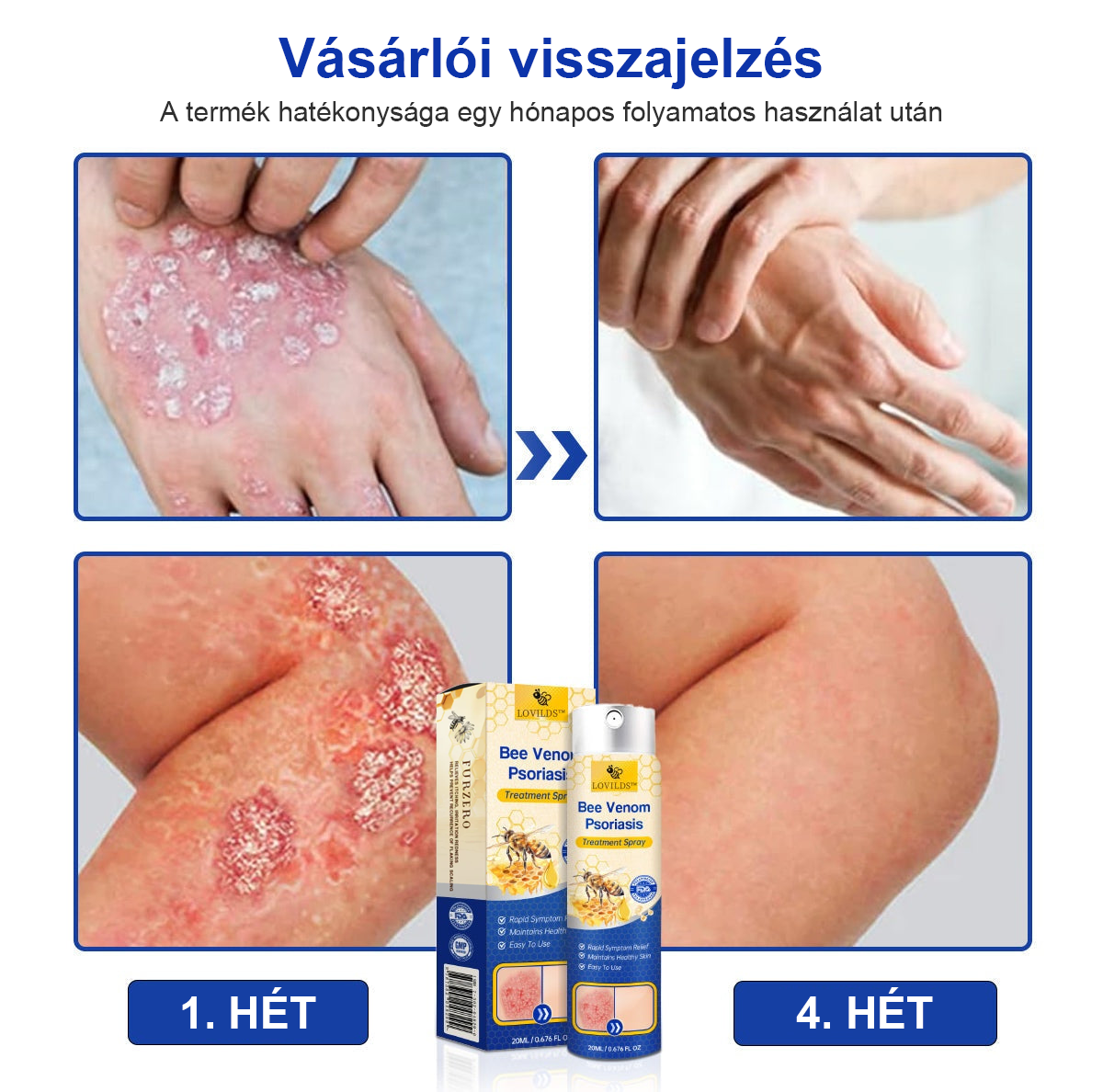 (🔥Utánvéttel🔥60% KEDVEZMÉNY) LOVILDS™ PsoriaHeal Psoriasis Spray (Szállítás világszerte – Ingyenes szállítás) 🌐