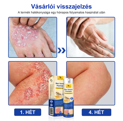 (🔥Utánvéttel🔥60% KEDVEZMÉNY) LOVILDS™ PsoriaHeal Psoriasis Spray (Szállítás világszerte – Ingyenes szállítás) 🌐