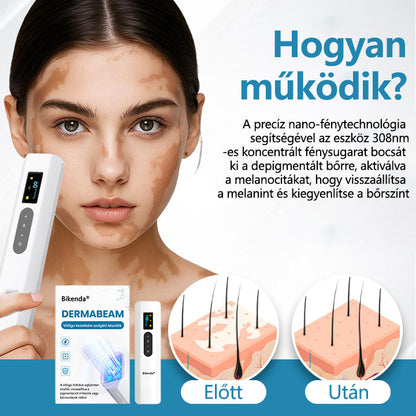 Bikenda® DermaBeam Vitiligo Therapy Device💙