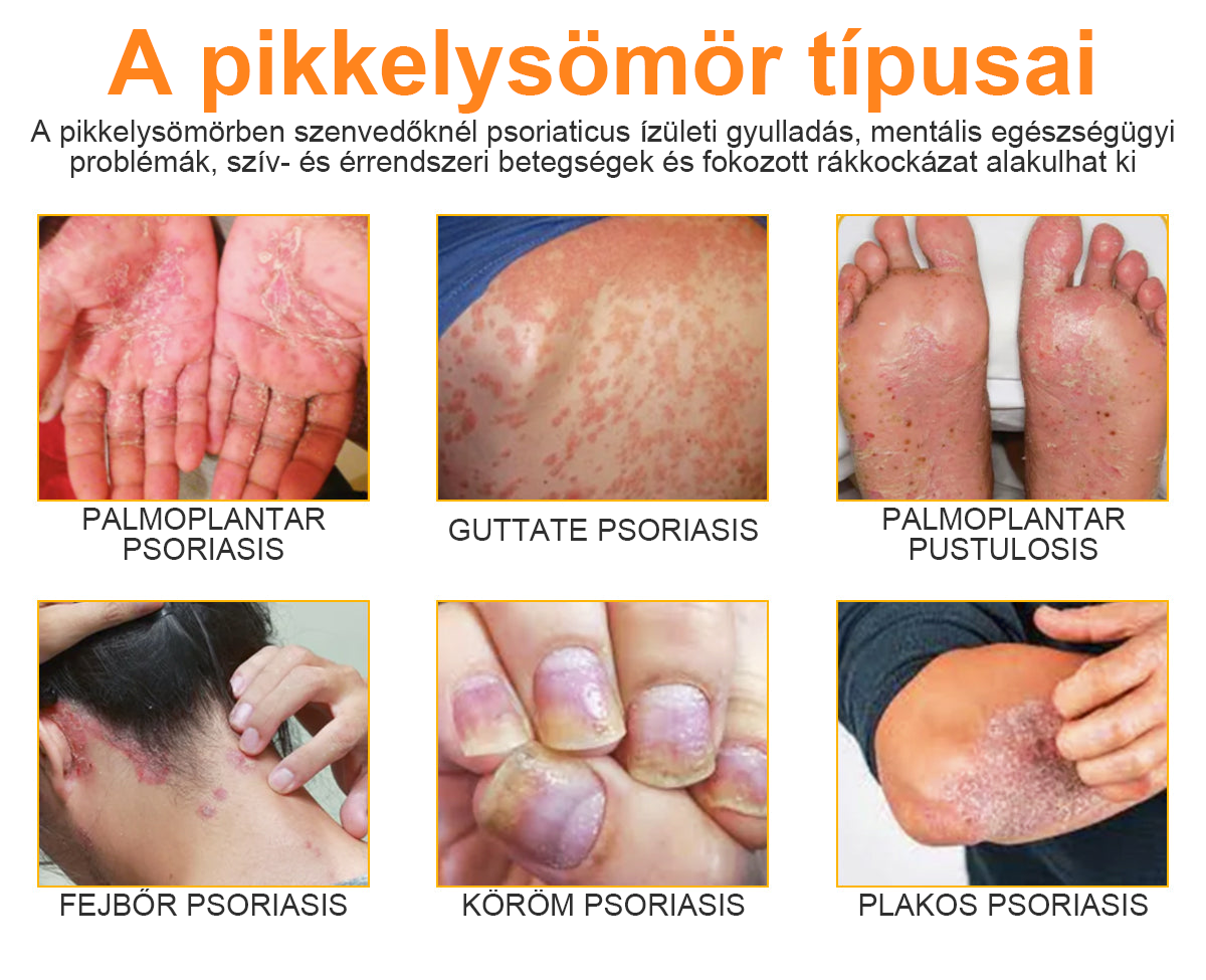 (🔥Utánvéttel🔥60% KEDVEZMÉNY) LOVILDS™ PsoriaHeal Psoriasis Spray (Szállítás világszerte – Ingyenes szállítás) 🌐