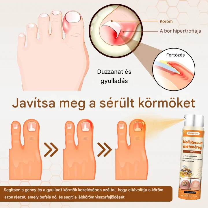 méhméreg spray – 2 hét alatt orvosolja a körömgombát! 🚀