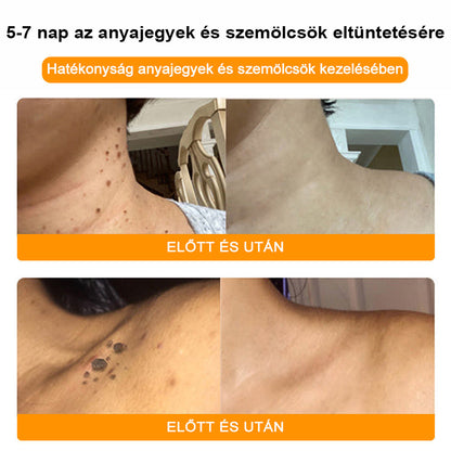 BSWELL® Méhméreg Kezelés Krém👨‍⚕️（AAD ajánlott） (🔥utolsó nap promóció 80% ki）