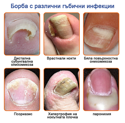 🐝Furzero™ Лечение на гъбички по ноктите с пчелна отрова: Пълно решение на проблема с гъбичките по ноктите🌟👣