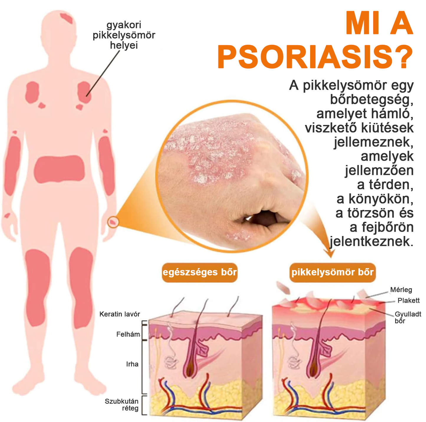 (🔥Utánvéttel🔥60% KEDVEZMÉNY) LOVILDS™ PsoriaHeal Psoriasis Spray (Szállítás világszerte – Ingyenes szállítás) 🌐